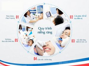 QUY TRÌNH NIỀNG RĂNG - CHỈNH NHA