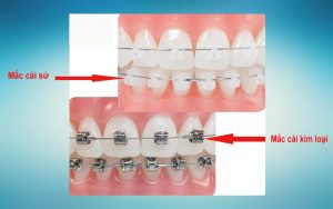 niềng răng mắc cài