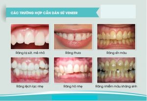 Những trường hợp tổn thương răng nào thì nên dán sứ Veneer ?