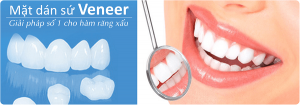 ƯU ĐIỂM CỦA MẶT DÁN SỨ VENEER KHÔNG MÀI RĂNG
