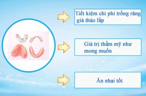 Hàm răng tháo lắp ở Nha khoa Quốc Tế Hoàn Mỹ có gì đặc biệt?