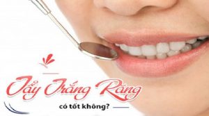 Tẩy trắng răng có hại hay không?