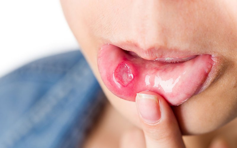 Các bệnh thường gặp ở răng miệng Viêm loét miệng