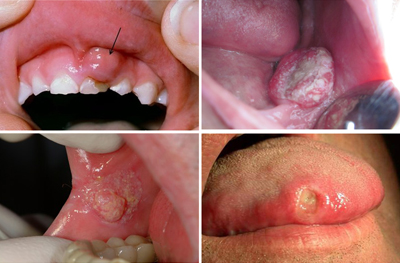 Các bệnh thường gặp ở răng miệng