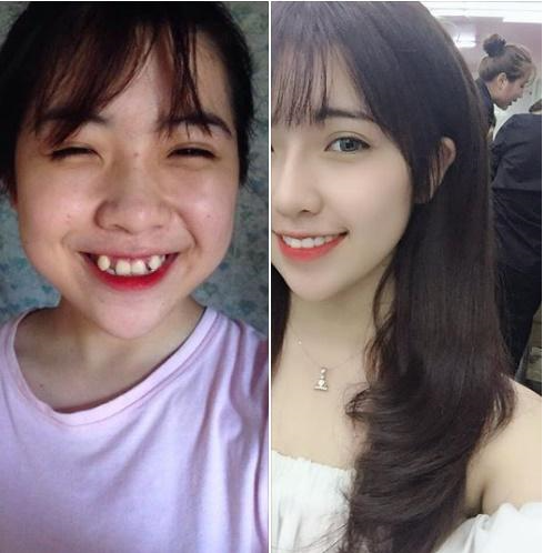 Dậy thì thành công nhờ niềng răng và những khó khăn khi niềng răng