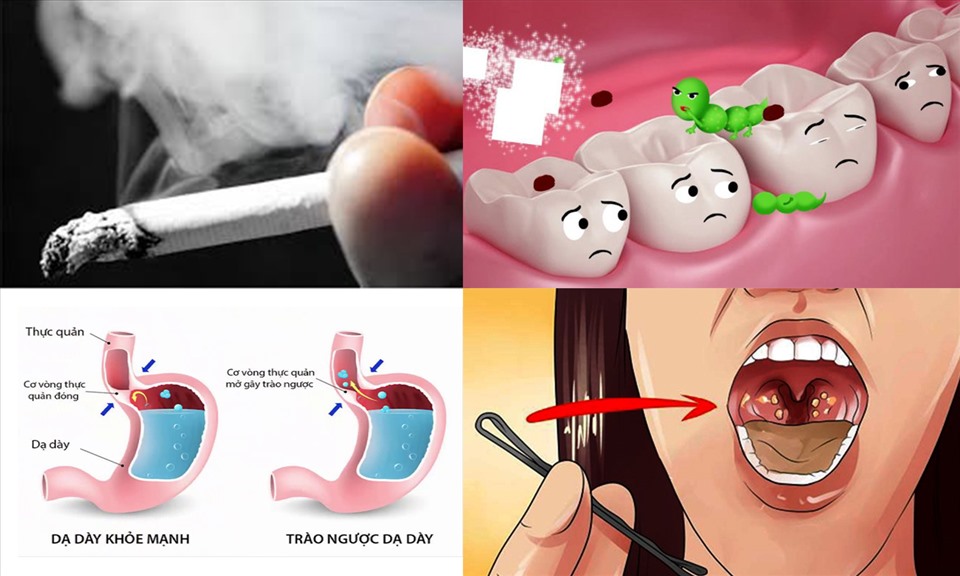 Nguyên nhân chính bị hôi miệng