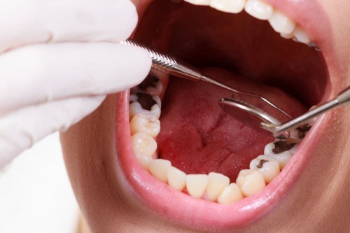 Trình trạng sâu răng hiện nay ở nước ta